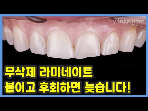 무삭제 라미네이트 신중히 결정해야 하는 이유?!  / #무삭제라미네이트 #치아성형